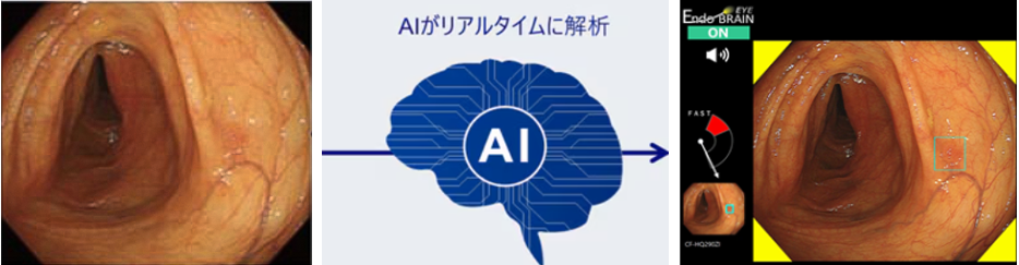 大腸内視鏡検査＋AI補助診断（EndoBrain）